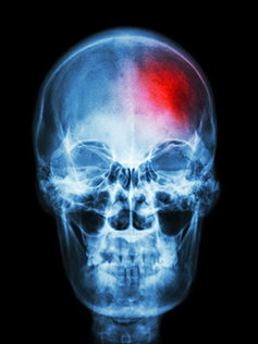 Skull scan - marijuana effects