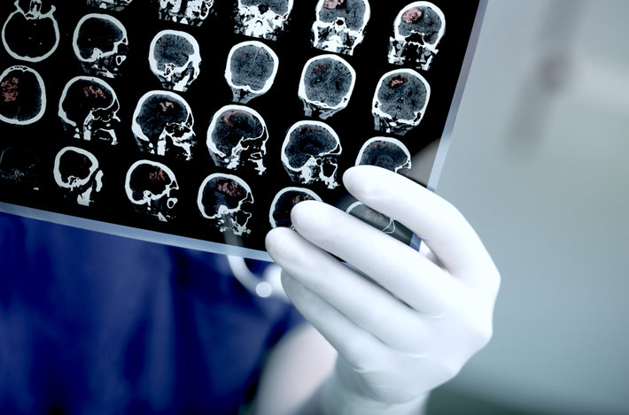 Doctor reviewing skull scan - marijuana effects cause a stroke