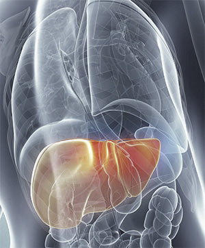 Cirrhosis Liver Alcoholism